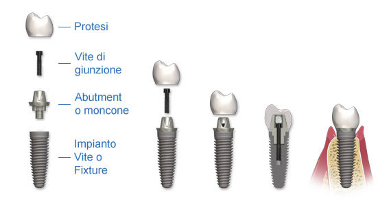 Quanto costa impiantare un dente all'estero ed in Italia?