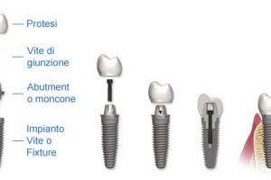 Quanto costa impiantare un dente all’estero ed in Italia?