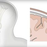 Neuralink di Elon Musk il Microchip nel Cervello per far Camminare i Tetraplegici