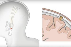 Neuralink di Elon Musk il Microchip nel Cervello per far Camminare i Tetraplegici