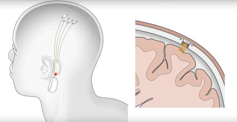 Neuralink di Elon Musk il Microchip nel Cervello per far Camminare i Tetraplegici